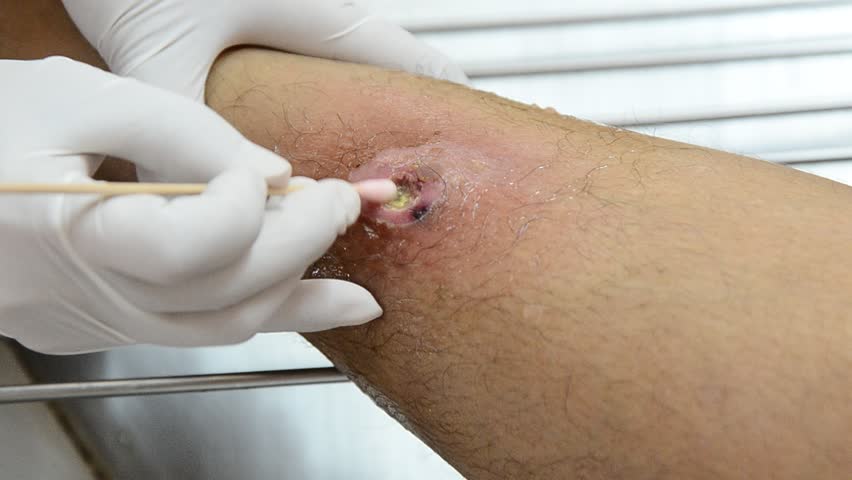 Header of Abscessed