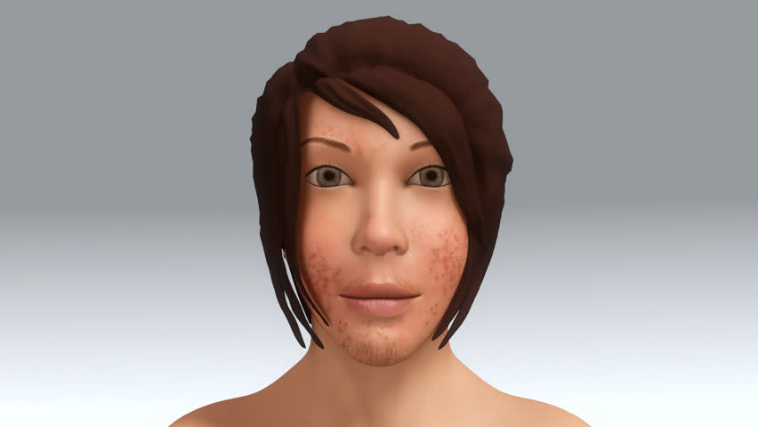 Header of Acne