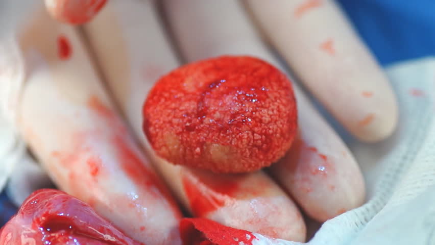 bladder stones diet calcium oxalate footage stock bladder stones diet calcium oxalate footage stock
