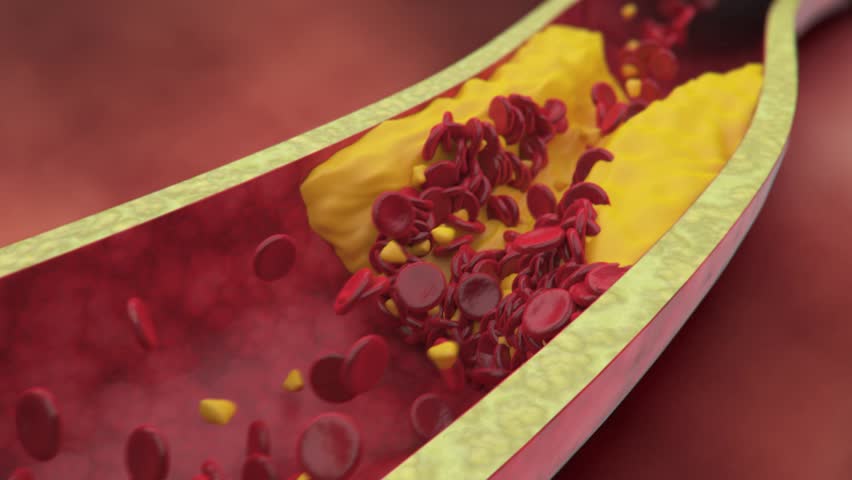 3D Footage Of The Effect Of Thrombosis (clot Formation) Within A