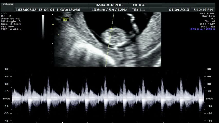 Ultrasound Scan Of A Baby Heart Beat Stock Footage Video ...