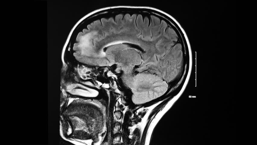 an-abnormal-mri-of-the-brain-showing-sclerotic-lesions-usually