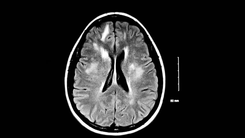 An Abnormal MRI Of The Brain Showing Sclerotic Lesions Usually ...